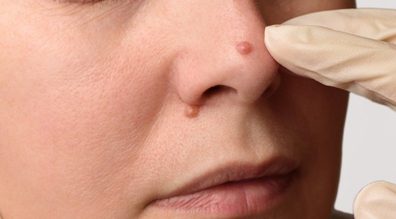 Warts Removal in Dubai: Safe Methods for Sensitive Skin